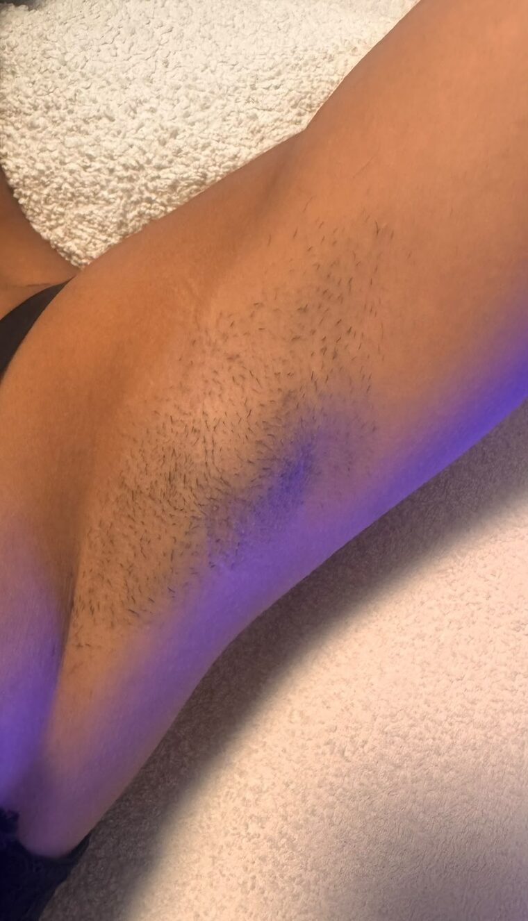Achselbereich mit sichtbarem Haarwuchs vor der ersten Laser-Behandlung